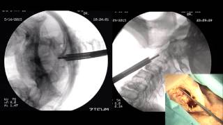 Odontoid Screw Fixation by Rick C Sasso MD [upl. by Imotas873]