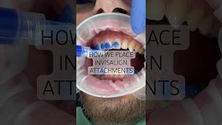 How we place Invisalign attachments or ‘buttons’… 🙌 invisalign newsmile viral [upl. by Viridi736]