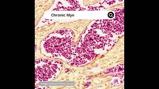 Chronic Myeloid Leukemia EN [upl. by Drusie]