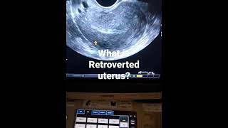 what is Retroverted uterusand how looks on tvs ultrasound [upl. by Danais]