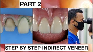 Step by Step 2 Indirect Veneer with Discoloration Tooth Part 2  General Dentist Griya RR [upl. by Hakkeber]