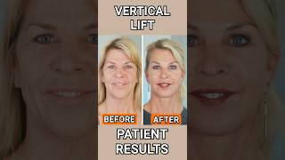 60 Year Old Woman Looks 15 Years YOUNGER antiaging goviral cosmeticsurgery [upl. by Glynnis]