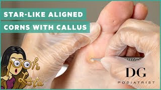 Starlike aligned corns with callus [upl. by Enelav]