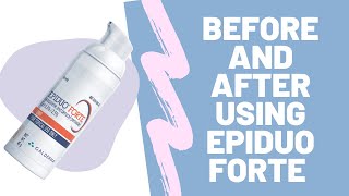 Epiduo Forte Before and After [upl. by Olegnad]