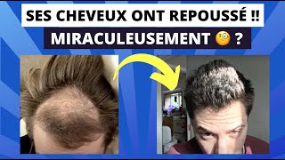 Calvitie  Ses cheveux repoussent en 9 mois avec ce Traitement 😱 [upl. by Merri]