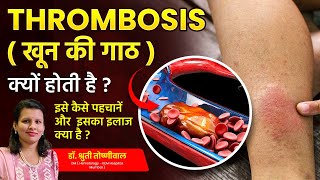 What is Thrombosis Whos at Risk and How to Prevent Blood Clots  Dr Shruti Toshniwal [upl. by Eikcor979]