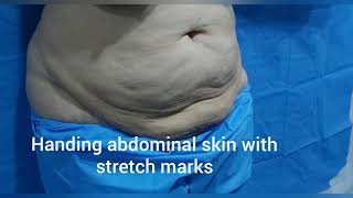 Lipoabdominopalstytummy tuckmummy makeover by dr Amin Yousaf [upl. by Ishmael]