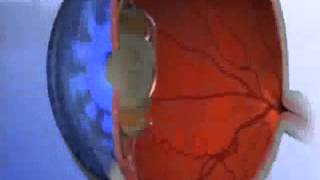 Multifocal Intraocular Lens How Does It Work [upl. by Weiss961]