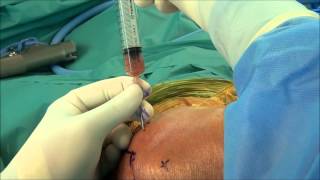 Septic Arthritis of Shoulder Joint Aspiration demo by DrBancha Chernchujitwmv [upl. by Stelmach]