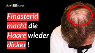 Folge 17 So macht Finasterid die Haare wieder dicker [upl. by Emersen27]