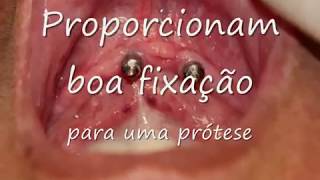 Como funciona uma overdenture com implante dentário  Prótese móvel com implantes dentários [upl. by Rekab456]