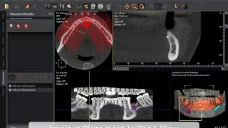 QuickVision 3D  Implant create and place  OWANDY RADIOLOGY [upl. by Dnomder]