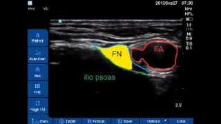 US guided femoral nerve block [upl. by Nahn]