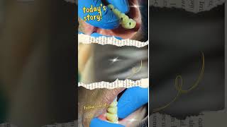 Follow Me For Full Implants installation Procedure insiders craft health shortsshortfeed [upl. by Niad769]