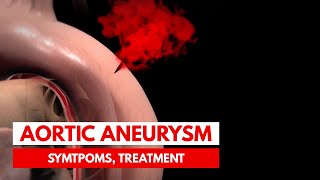 What is an Aortic Aneurysm  3D Animation [upl. by Akimrej]