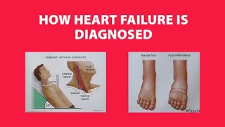 How Heart Failure is Diagnosed [upl. by Neffirg]