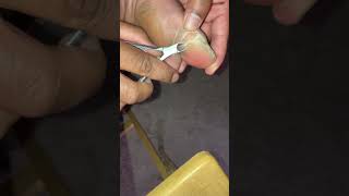 Removal of super CALLUS on big toe [upl. by Janicki]