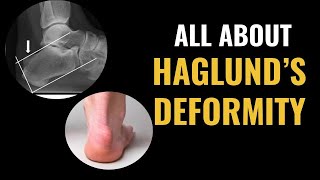 How Do I Treat A Haglunds Deformity [upl. by Maxa]