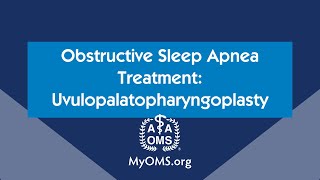 Obstructive Sleep Apnea Treatment Uvulopalatopharyngoplasty [upl. by Tikna]