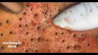 how to removal blackhead and how to get rid of blackhead blackhead on face 60 [upl. by Kronfeld740]