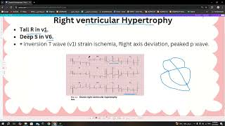 سلسلة الECG المحاضرة 5 Chamber Enlargement [upl. by Yeclek]