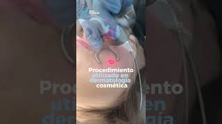 Tratamiento para cicatrices de acné con láser Co2  Skin Hospital  acne [upl. by Bayly]