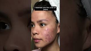 Dear Acne I HATED You acne acneawareness mentalhealth [upl. by Tayib]