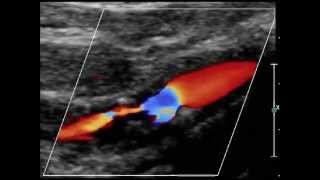 hemodynamic stenosis of the internal carotid artery [upl. by Noella]