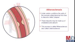 Coronary Artery Bypass Surgery [upl. by Nytsrik]