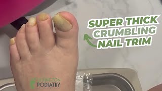 SUPER THICK Crumbling Nail Trim [upl. by Eixel]