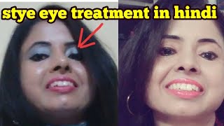 stye eye treatment in hindi  guheri ka ilaj  chalazion treatment [upl. by Armelda]