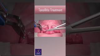 Tonsillitis Treatment With Heat Device tonsillitis [upl. by Erma]