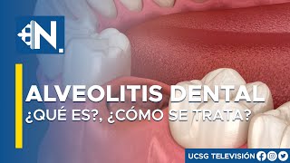 Alveolitis dental ¿Qué es y cómo se trata l Lo mejor del día Viva Mejor TV [upl. by Pia586]