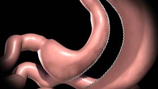 Realize Sleeve Gastrectomy Procedure Animation [upl. by Deyes]