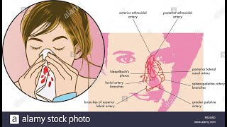 hemorragie Hémorragie nasale  astuces naturelles [upl. by Thessa]