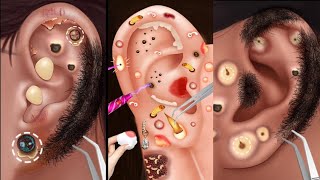 quotDeep Ear Cleaning ASMR Removing Pus Earwax amp Itchy Stones for Relaxationquot [upl. by Somisareg366]