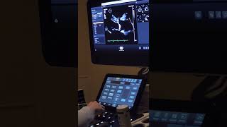 Heart Echo Ultrasound echocardiogram in Progress 120823 [upl. by Naujej]