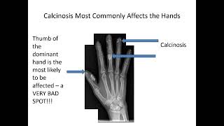 Calcinosis in Scleroderma Carrie Richardson MD MHS [upl. by Haymes]