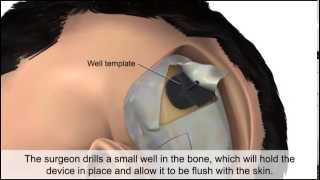 Cochlear Implant [upl. by Relyuc]