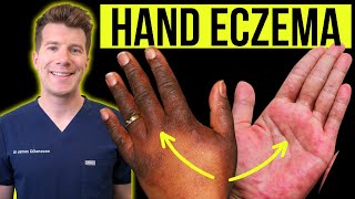 Doctor explains how to recognise and treat HAND ECZEMA dermatitis  Causes symptoms amp prevention [upl. by Assirram]