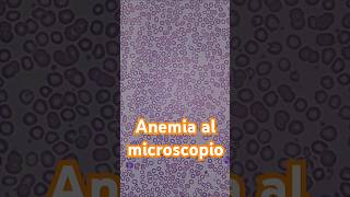 Así se ve la anemia al microscopio hematología anemia laboratorioclinico [upl. by Mcquade]