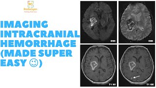 Brain Hemorrhage CT  MRI Made Super Easy  Radiology Video Tutorial [upl. by Nahsaj]