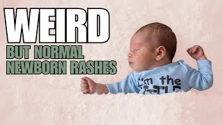 Newborn Baby Rashes on Face and Skin [upl. by Eresed]