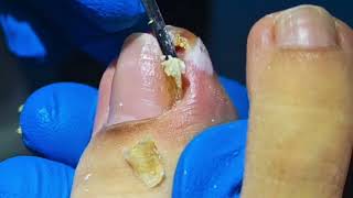 WARNING Dont Try to Remove an Ingrown Toenail Without Watching This [upl. by Flodur]