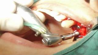 implantes dentales en argentina precios  Apsectos a Tener en Cuenta al Seleccionar implantes [upl. by Aicelet852]