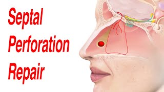 Septal Perforation Repair [upl. by Cyb]