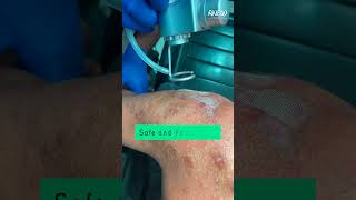 LASER TREATMENT FOR KELOID [upl. by Auliffe732]