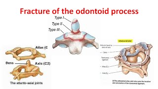 Fracture of the dens Odontoid process Classification clinical features amp treatment [upl. by Sklar]