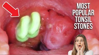 Tonsil Stones amp Removal At Home Compilation  Most Popular [upl. by Ardnasela]