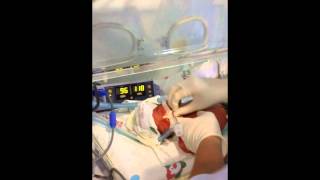 Neonatal Digital intubation by a First Year Fellow [upl. by Murial708]